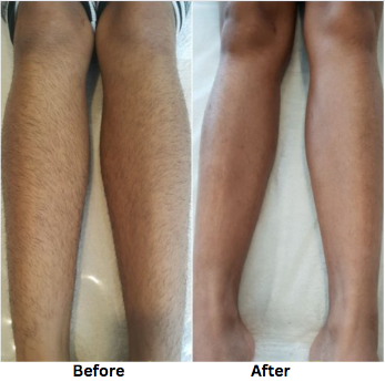 in Permanent Hair Removal